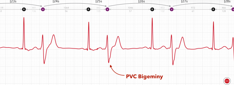 A PVC Bigeminy pattern is marked on an Apple Watch ECG report in ECG+
