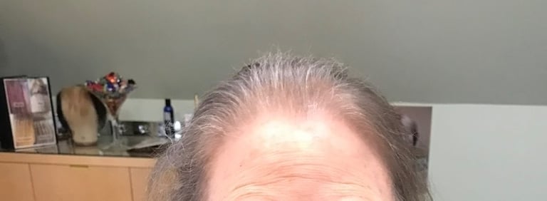 Before permanent non-surgical hair replacement #7 – fine, wispy hair lacking volume – woman in Danve
