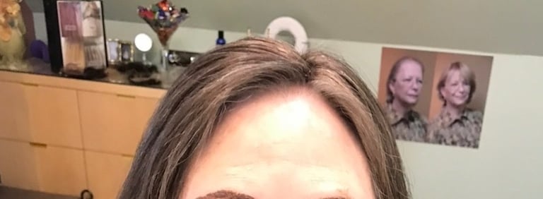 After permanent non-surgical hair replacement #7 with strand by strand method – thicker, fuller-look