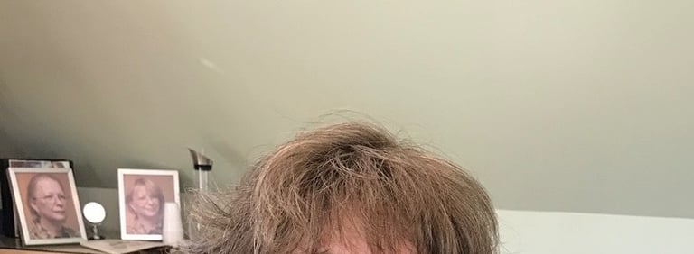 After permanent non-surgical hair replacement #6 with integration method – even coverage and natural