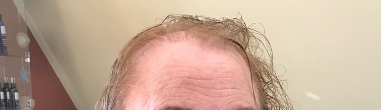 Before permanent non-surgical hair replacement #5 – thinning on top with flat, limp sides – woman in