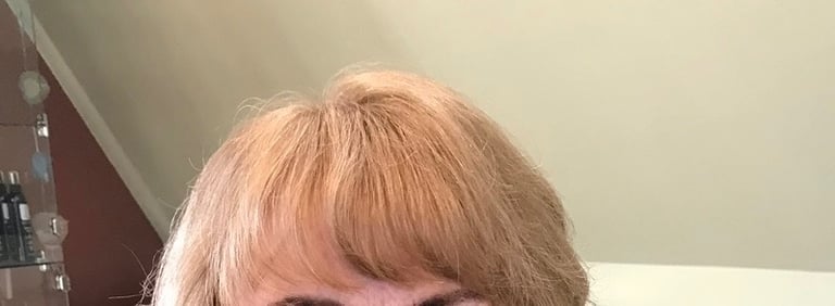 After permanent non-surgical hair replacement #5 with Micropoint Helix solution – fuller top and sid