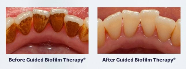 picture of dental staining removal