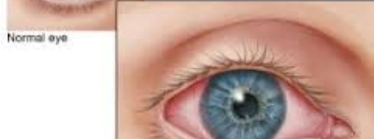 التهاب القزحية أو الشبكية