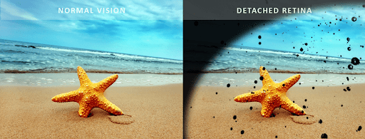Normal eye vs eye with retinal detachment explaining about how vision with RD look like.