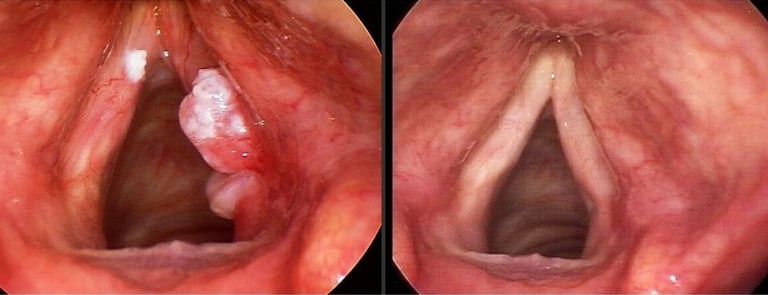 🔊 When the Voice Speaks of Illness : Vocal Cord Cancer