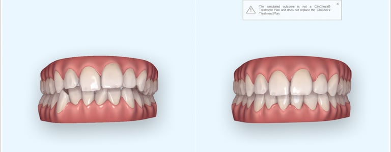 Invisalign before & after