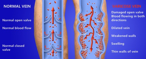 Medical diagram comparing a normal vein with healthy valves to a varicose vein with damaged valves and pooling blood.