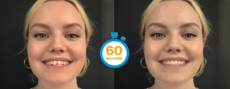 Invisalign simulation