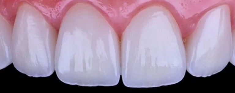 diseño de sonrisa