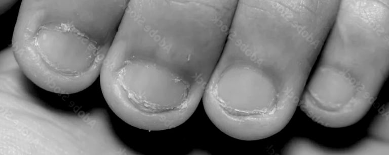 Bitten Nails