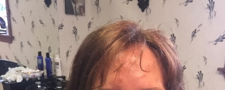 After permanent non-surgical hair replacement #4 with strand by strand method – softer, denser front