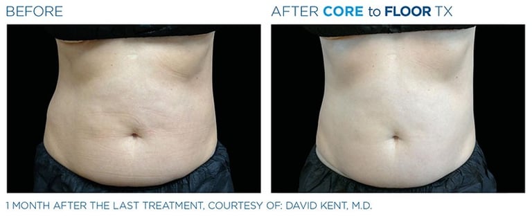 Before and after photos of a person&amp;amp;#x27;s torso standing up showing more body sculpting