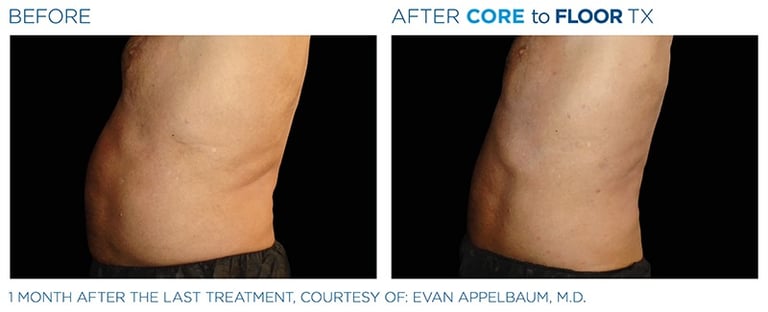 Before and after photos of a person&amp;amp;#x27;s torso standing up showing more body sculpting