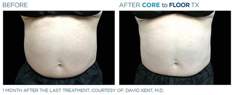before and after pictures of a mans abdomen showing emsculpt neo treatment