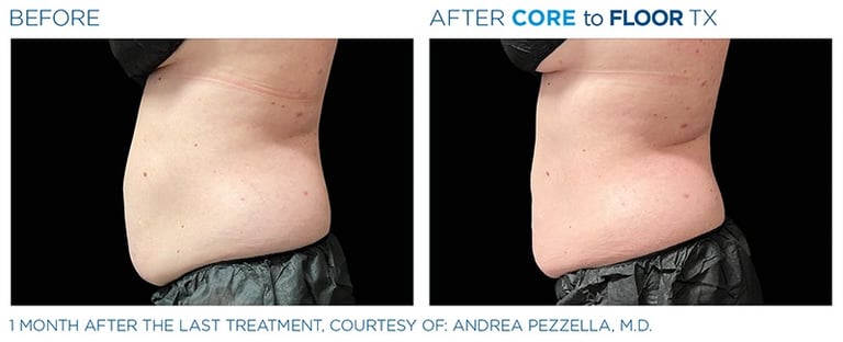 before and after pictures of a mans side-view showing emsculpt neo treatment