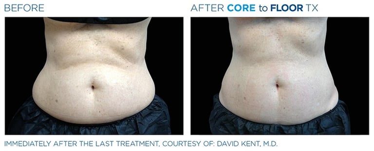 before and after pictures of a womans abdomen showing emsculpt neo treatment