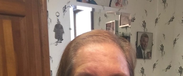 Before permanent non-surgical hair replacement #4 – receding and thinning front hairline – woman in 