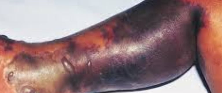 Necrotizing fasciitis Flesh-eating Fournier’s gangrene & novel treatment  