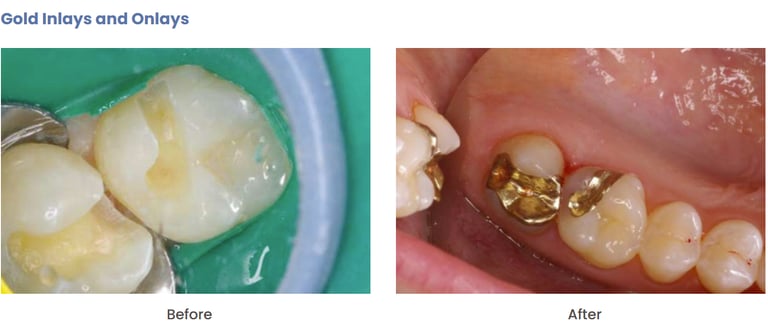 picture of dental gold fillings
