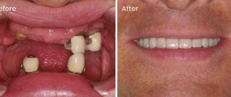 picture of a man with a denture