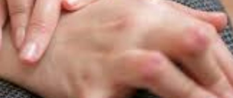 التهاب المفاصل الروماتويدي : نهج متعدد في العلاج - الصيام
