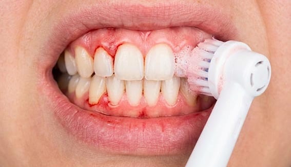 Las desventajas de los cepillos dentales rotativos hygiene-precision.com