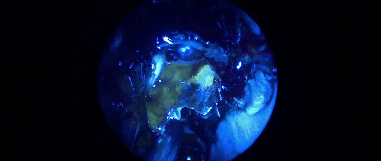 Endoskopski prikaz likvoreje obojene fluoresceinom – istjecanje cerebrospinalne tekućine kroz nos 