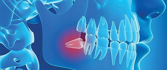 Soins dents de sagesse hygiene-precision.com