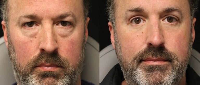 eyelid surgery before after in Antalya