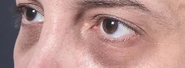 Dark Circles ray and rio's speciality clinic