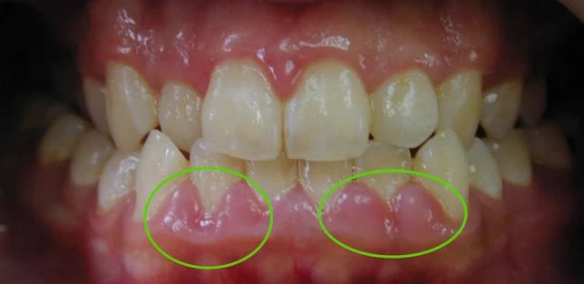 a image showing swollen gums