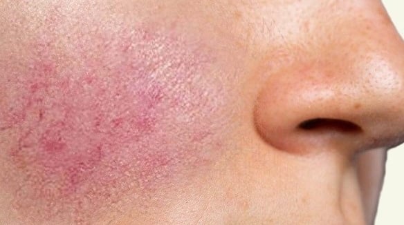 Rosacea in a young girl
