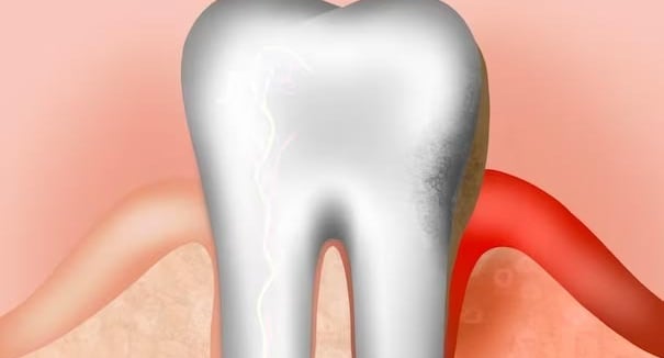 Ozone pour soigner les tissus de soutien des dents hygiene-precision.com