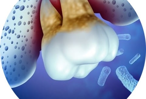 parodontite avant et après traitementsoins jet dentaire ozone hygiene-precision.com