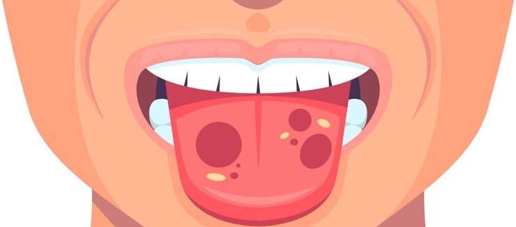 Stomatites hygiene-precision.com