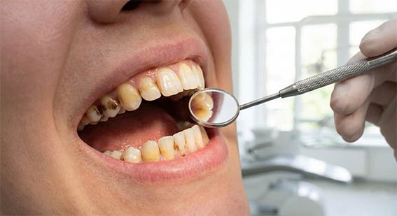 Taches sur les dents hygiene-precision.com