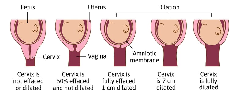 a diagram of how the cervical tissue thins and the cervical opening widens during labor