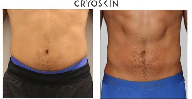 Cryolipolyse avant apres