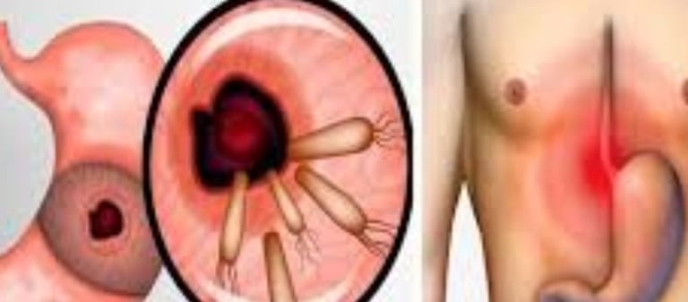 عسل مانوكا لبكتيريا الهيليكوباكتر بيلوري (H. pylori) والصيام