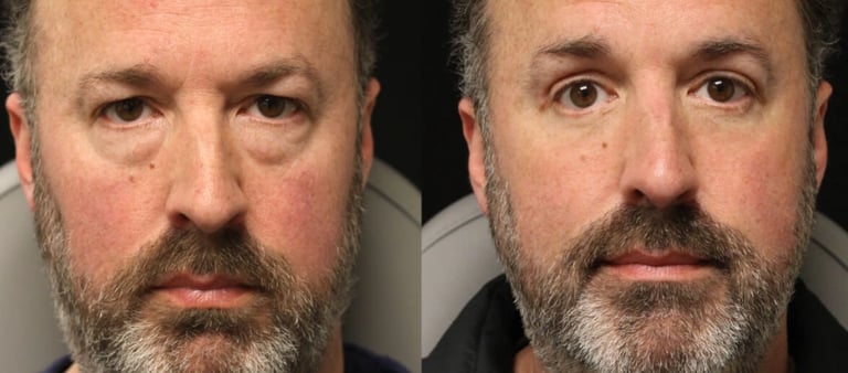 Vorher-Nachher-Fotos einer Augenlidoperation in Antalya.