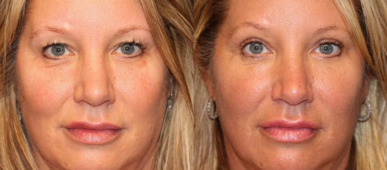 Vorher-Nachher-Fotos einer Augenlidoperation in Antalya.