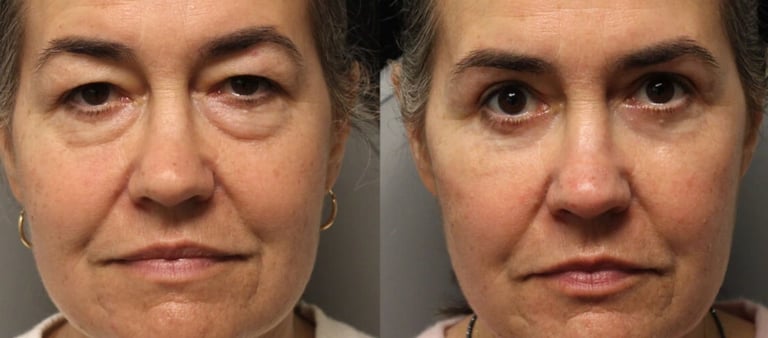 Vorher-Nachher-Fotos einer Augenlidoperation in Antalya.