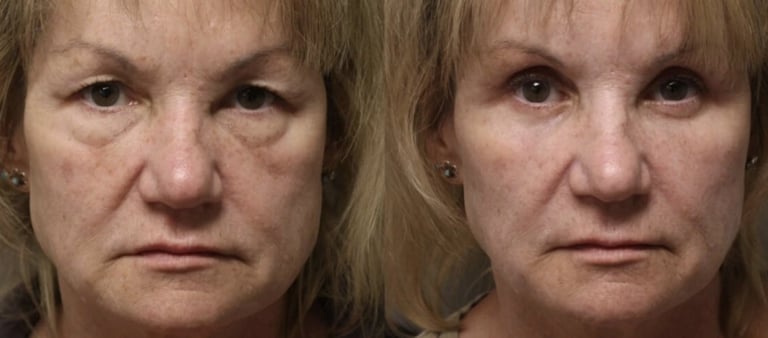 Vorher-Nachher-Fotos einer Augenlidoperation in Antalya.