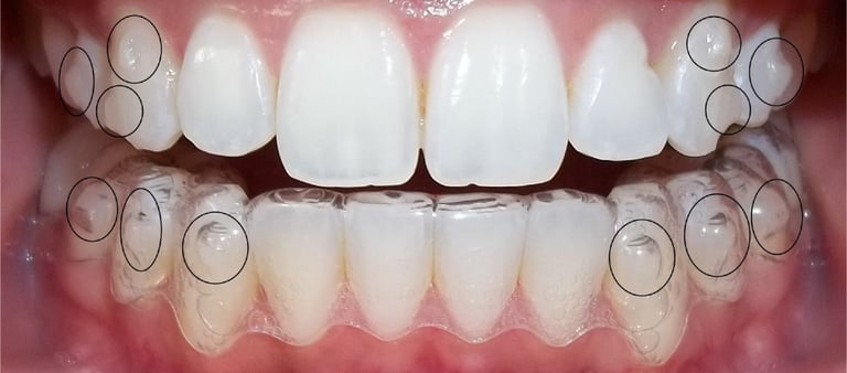 invisalign