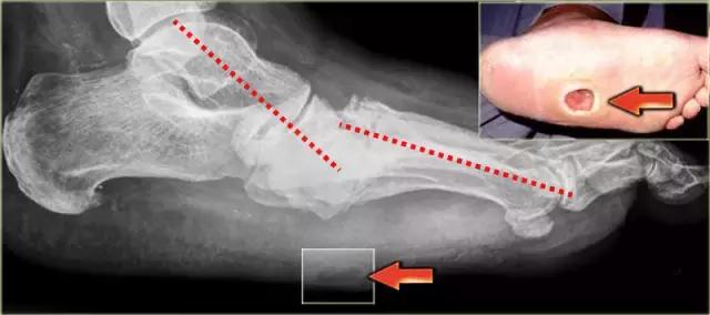 pie de Charcot