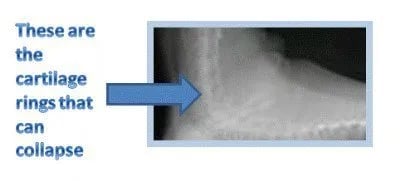 exray image of trachea collapse