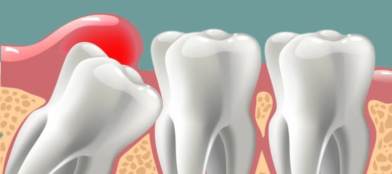 wisdom tooth stuck & paining and needs removal by Oral Surgeon in Malad