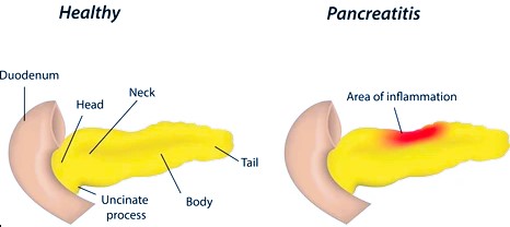 pancreatitis