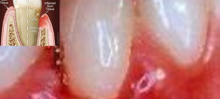 gums disease 